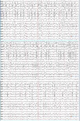 Differential Functional Changes of Nav1.2 Channel Causing SCN2A-Related Epilepsy and Status Epilepticus During Slow Sleep